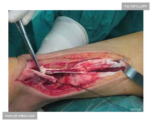 羽毛球运动医学创新跟腱断裂康复周期缩短至六个月大幅提升运动员恢复速度